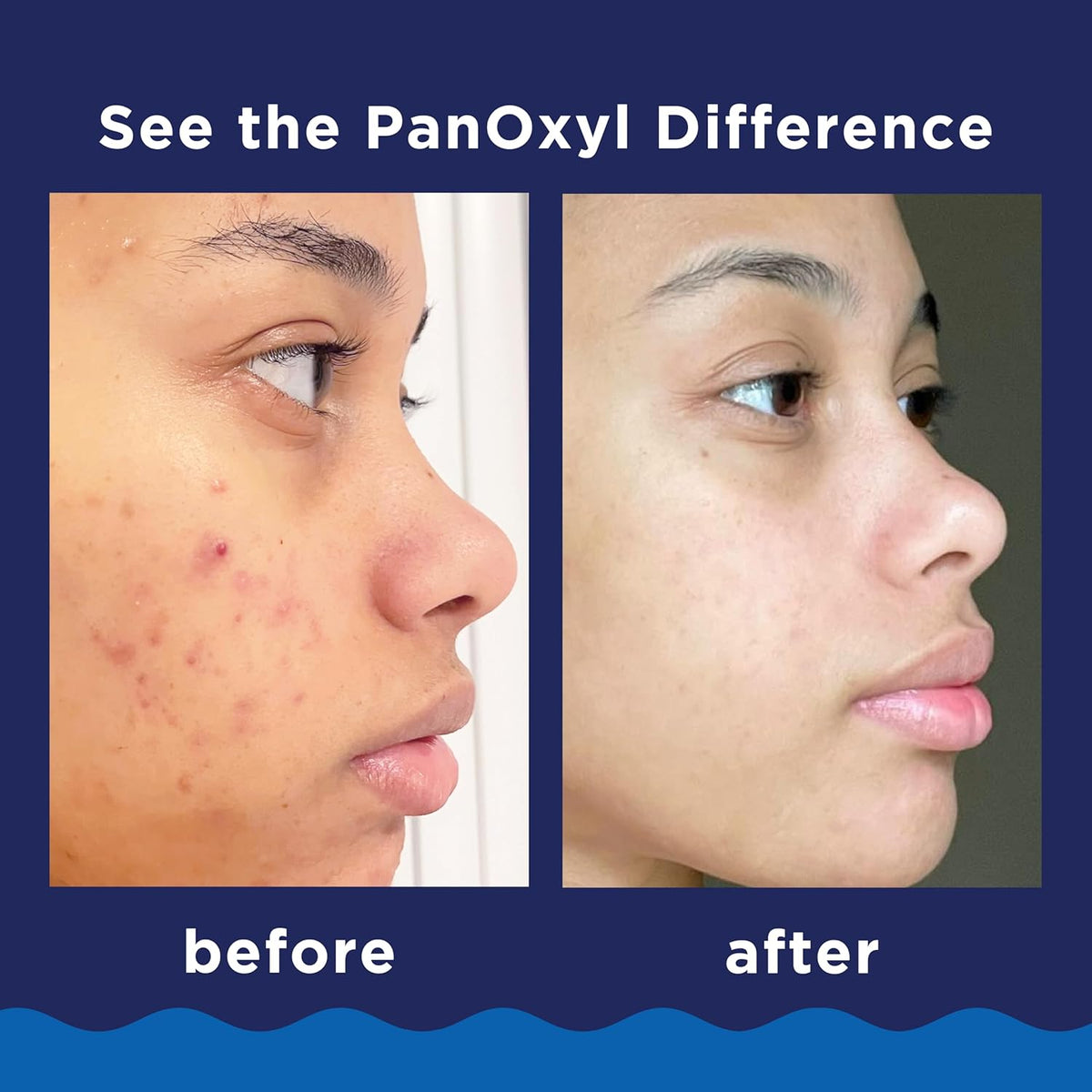 PanOxyl acne-prone skin face wash and body wash