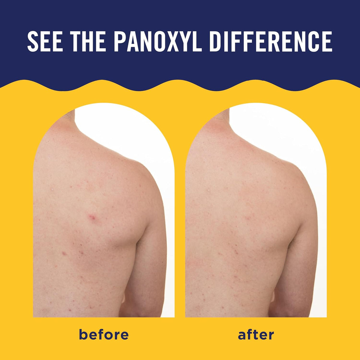 PanOxyl leave-on body blemish spray bottle