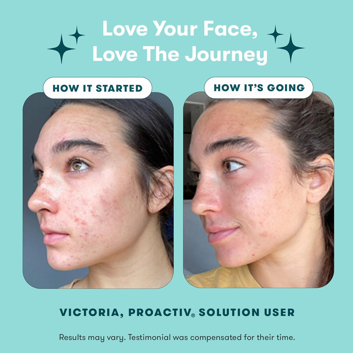 Proactiv acne treatment system with benzoyl peroxide