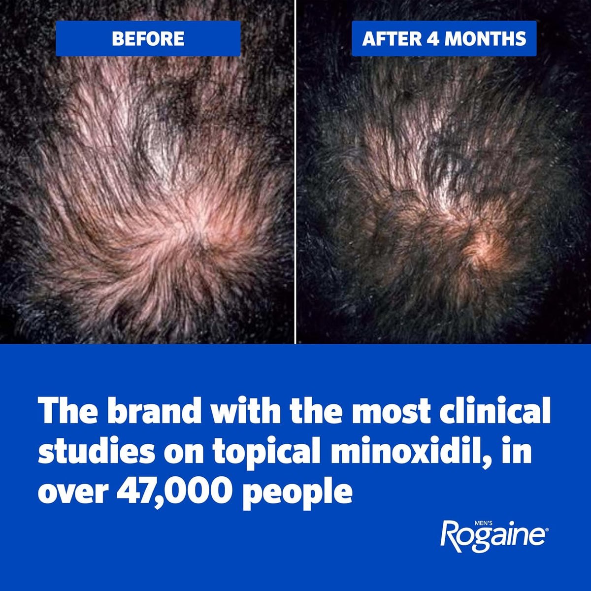 Rogaine extra strength minoxidil foam value pack